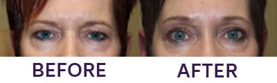 Endoscopic brow lift upper eyelid bleph before and after